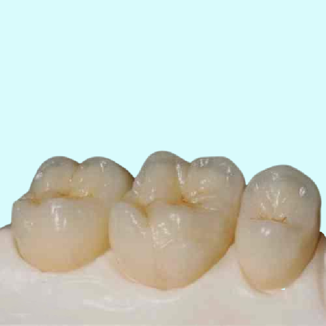High Strength Zirconia Ceramic Teeth Precision Digitally Manufactured