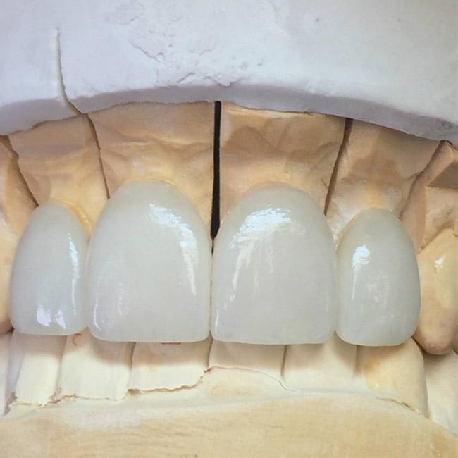 Body Strength Thin Zirconia Crown Durable Natural Realistic Restoration