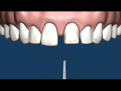 CO CR MK1 Precision Attachment Denture Corrosion Resistance