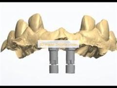 3D model Zirconia crown