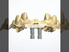 3D model Zirconia crown