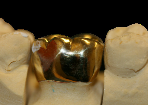 High Density Fine Protection FMC Crown Bridge Dental Laboratory