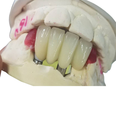 Strong Ti Base Milling Dental Implant Crowns Tooth Supported Bridge
