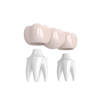 Realistic Appearance Bridges And Dental Crowns Strong Stability Natural Color