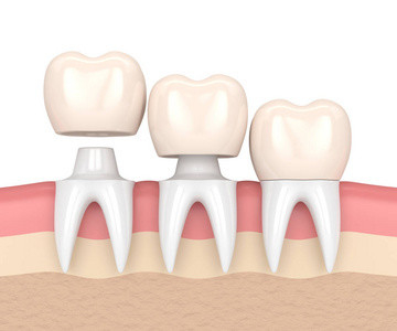 Good Biocompatibility Dental Crowns And Bridges Not Easy To Wear Color Stable
