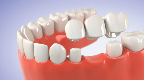 Porcelai CrownRealistic Color Stable Color Not Easy To Break Porcelain