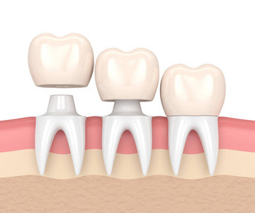 Beautiful Dental Crowns And Bridges Smooth Surface For Oral Hygiene Safety