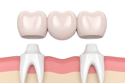 Oral Hygiene Safety Porcelain Tooth Crown High Wear Resistance High Finish