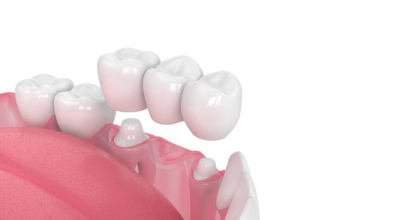 Porcelain Dental Crown Acid And Alkali Resistance Good Biocompatibility