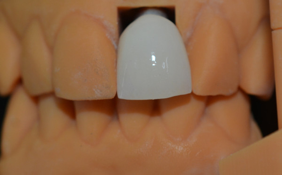 Redefining Aesthetics Our Natura Looking Dental Implant Crowns