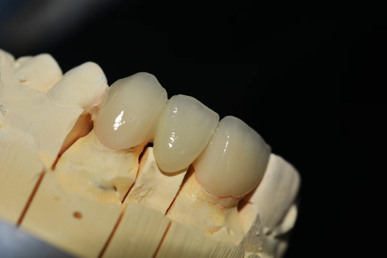 Customized Zirconia Denture Dental lab - Fast Delivery and Repair