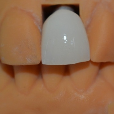 The Strength Behind Our Success Our Dental Implant Crown Technicians