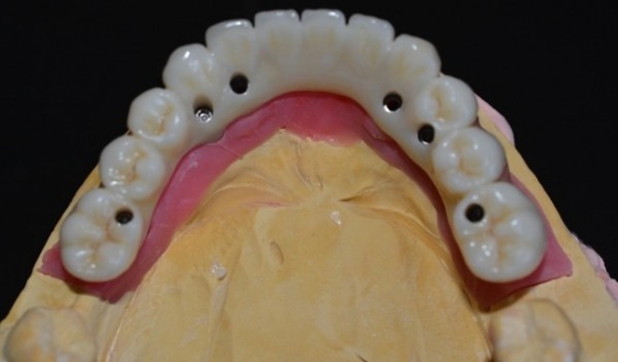 Elevating Standards Our Dental Implant Crown Quality Assurance