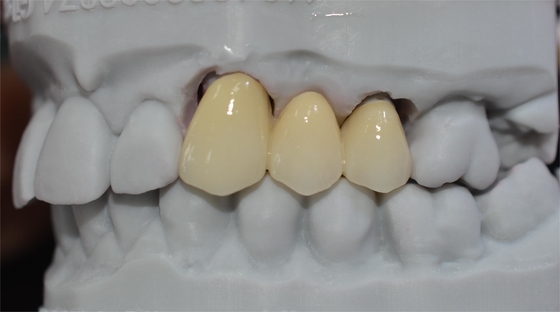 Longevity And Durability A Lifetime Investment With Our Ceramic Dental Crowns