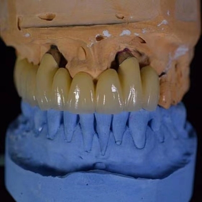 Strong Transparency Ceramic Dental Crown Good Abrasion Resistance Long-lasting