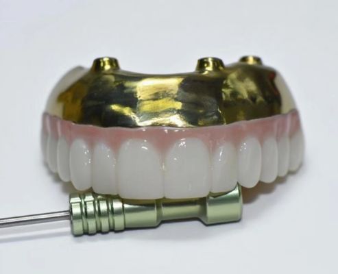 Full Zirconia Bridge With Titanium Bar Support, Long-lasting Titanium Bar Supported Zirconia Crowns With Bridges
