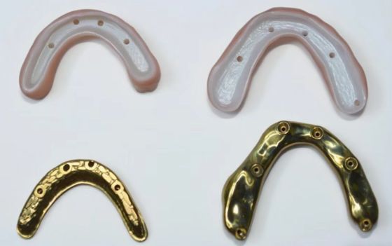 Full Zirconia Bridge With Titanium Bar Support, Long-lasting Titanium Bar Supported Zirconia Crowns With Bridges