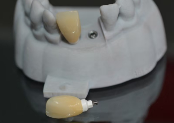 CAD PEEK custom abutment