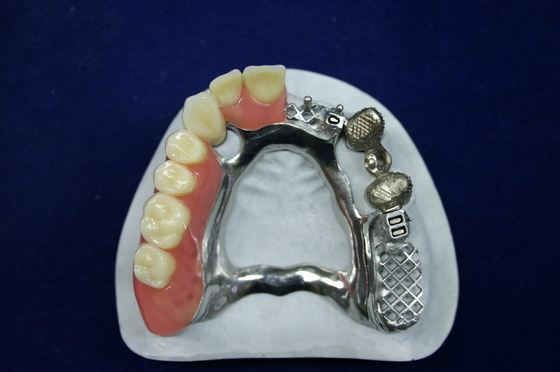 Beautiful Appearance Precision Attachment Denture Implant Attachments