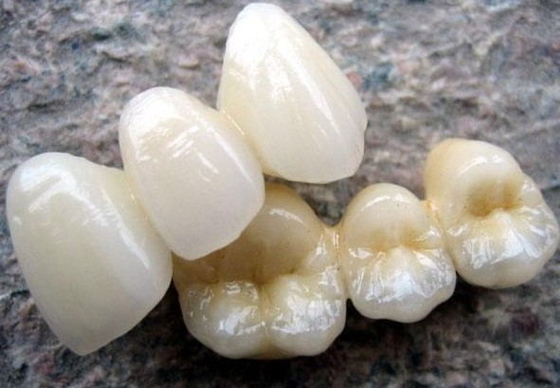High Biocompatibility PFM Crown Porcelain Fused For Back Teeth Restoration