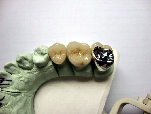 High Biocompatibility PFM Crown Porcelain Fused For Back Teeth Restoration