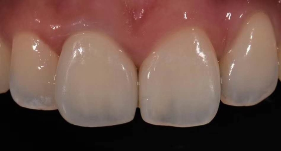 High Biocompatibility PFM Crown Porcelain Fused For Back Teeth Restoration