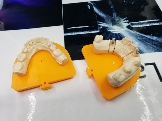 Full Metal PFM Dental Crown Bridge High Tech Biological Material