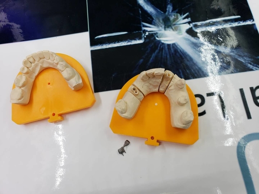 Full Metal PFM Dental Crown Bridge High Tech Biological Material