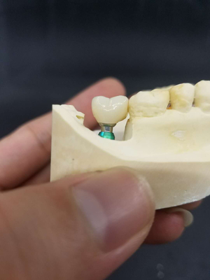 Smooth Surface Biocompatible Zirconia Tooth Crown Easy Maintain
