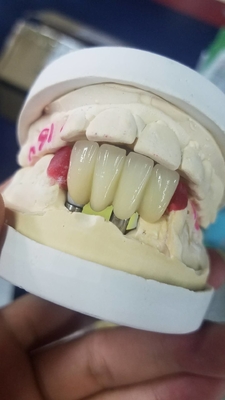 Smooth Surface Biocompatible Zirconia Tooth Crown Easy Maintain