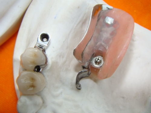 Dental Lab Long Lasting Precision Attachment Denture Stain Resistant