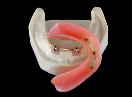 High Biological Inter Miscibility Denture Dental Lab Safety Implant