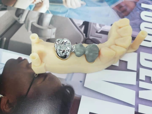 Customized Digital All Metal FCC crowns & bridges Nickel Chromium