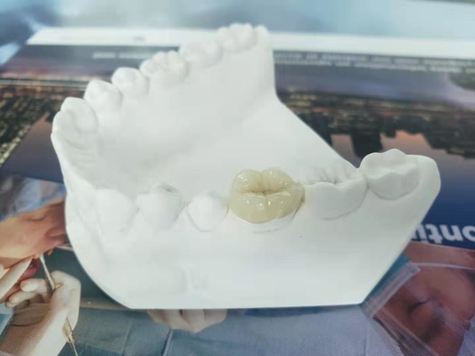 Durable FDA All-Ceramic Dental Crown Veneer Inlay Onlay Similar