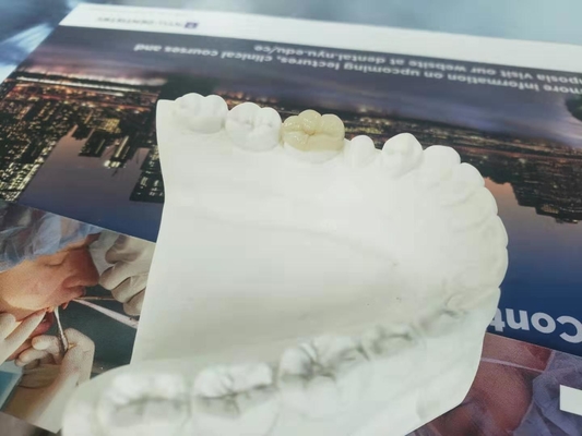 Durable FDA All-Ceramic Dental Crown Veneer Inlay Onlay Similar