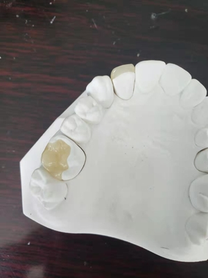 Durable FDA All-Ceramic Dental Crown Veneer Inlay Onlay Similar