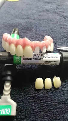 Resin-Based CAD-CAM Fixed Removable Bridge Aesthetics Restoration