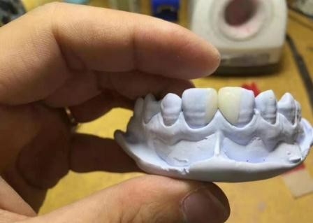 Efficient Resin Removable PFM Dental Crown Health Materials