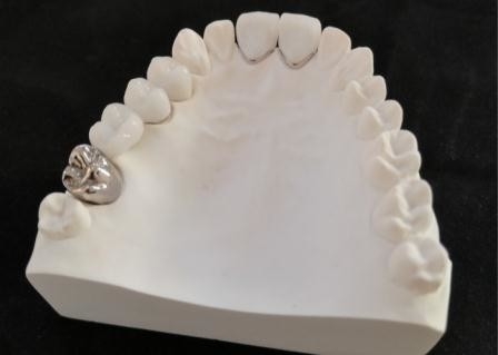 Customized PFM Porcelain Dental Crown Full Metal Corrosion Resistance