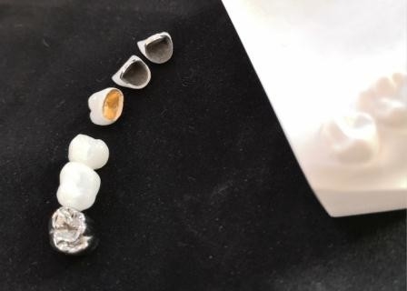 Customized PFM Porcelain Dental Crown Full Metal Corrosion Resistance