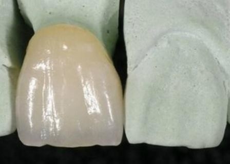 Smooth Surface PFM Metal-Ceramic Crown Corrosion Resistant
