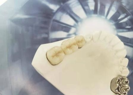 OEM Polishing Porcelain Dental Crown High Biological Intermiscibility