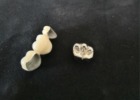 OEM Polishing Porcelain Dental Crown High Biological Intermiscibility