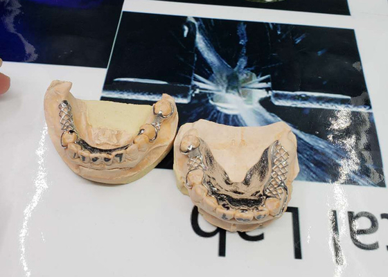 High Accuracy CAD-CAM Fixed Removable Bridge Digitization Design