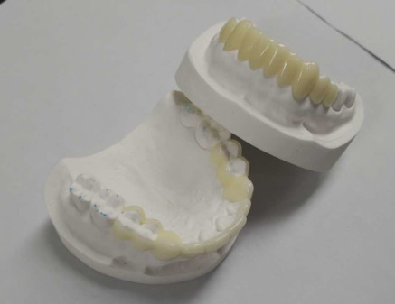 High Durability CAD CAM 3D Printing Temporary Crowns Durable Resin