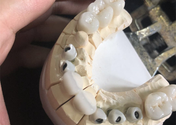 Metal Free White Zirconia Dental Crowns Excellent Biocompatibility