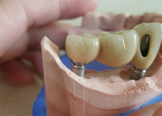 CAD CAM Zirconia Dental Crown With Titanium Base Zirconia Abutment