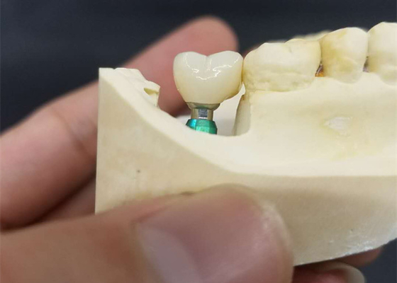 Ultra Hard Colour Stability OEM Dental Implant Crown Easy Maintain
