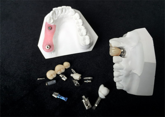 High Durability Zirconia Dental Implant Crown For Dental Restoration