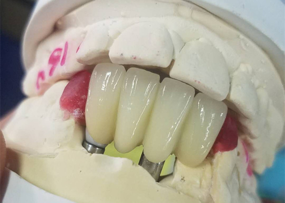 Strong Ti Base Milling Dental Implant Crowns Tooth Supported Bridge